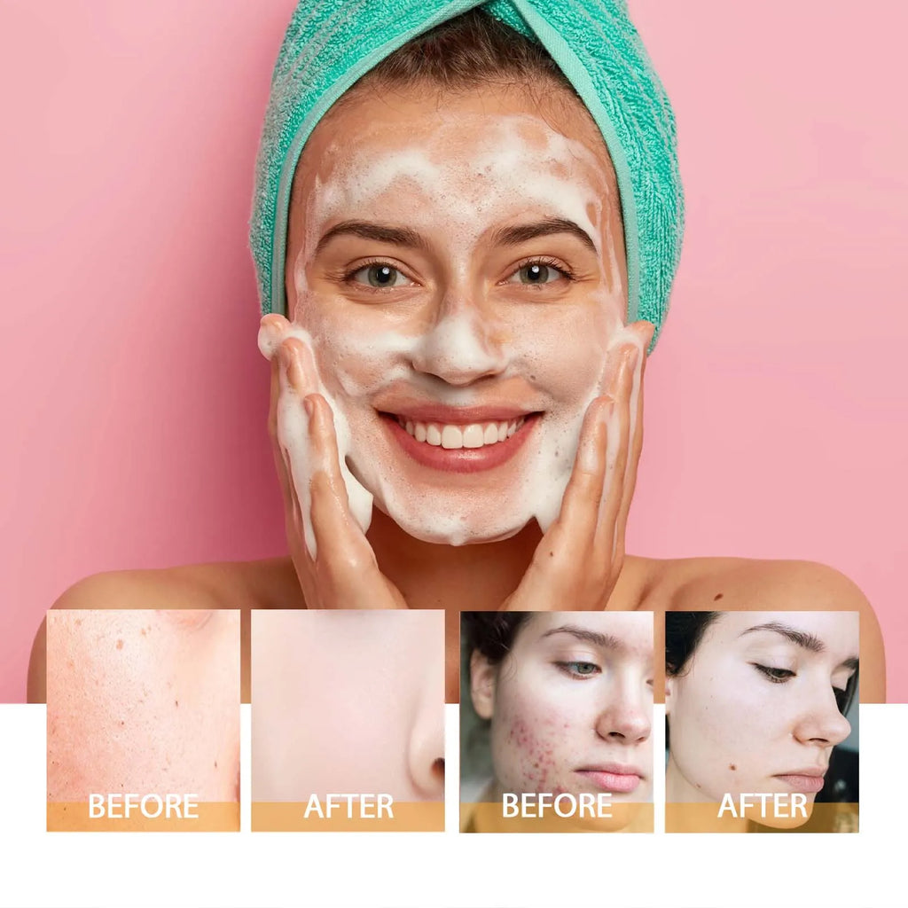 Turmeric Kojic Acid Face Wash – Deep Cleansing Brightening Oil Control Cleanser